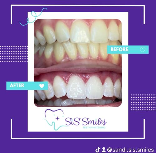 SiS Smiles – Teeth Whitening